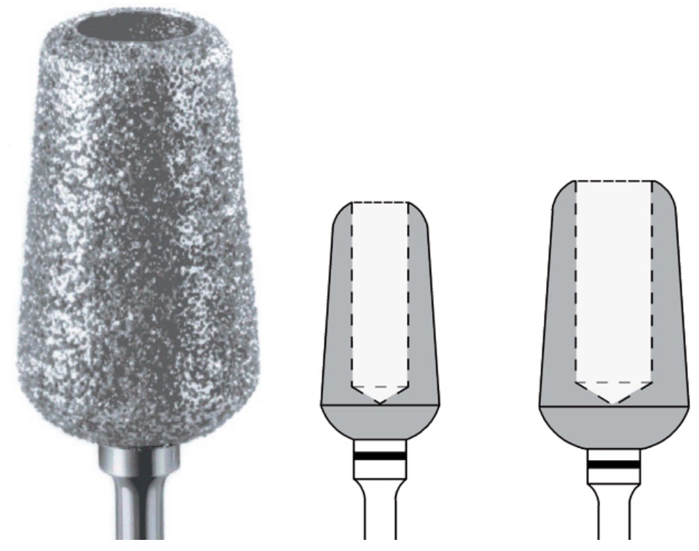 Busch Diamantschleifer 5405, Hohlschleifer, super grobe Körnung, 1 Stück